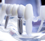 השתלת שיניים ממוחשבת: הדור הבא-תמונה